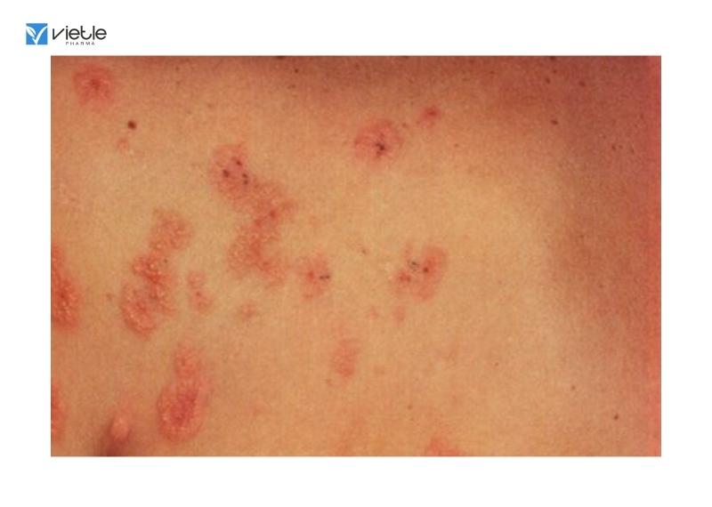 Bệnh viêm da dạng herpes của Duhring-Brocq
