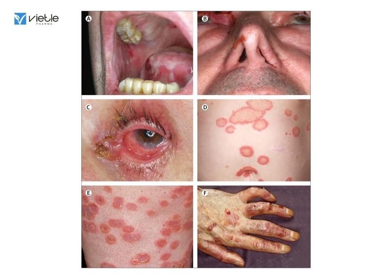 Bệnh viêm da dạng herpes của Duhring-Brocq