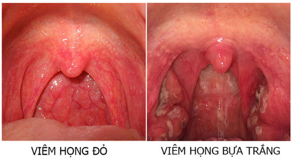 VIÊM HỌNG CẤP