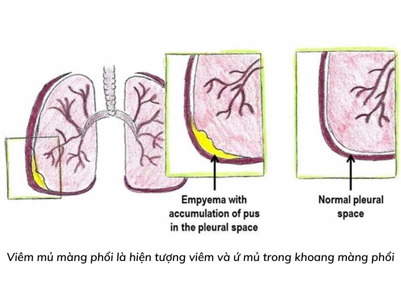 viêm mủ màng phổi