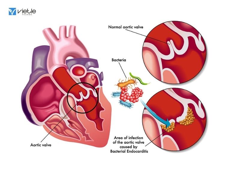 Viêm nội tâm mạc nhiễm trùng ở trẻ em
