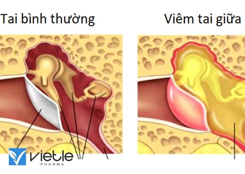viêm tai giữa