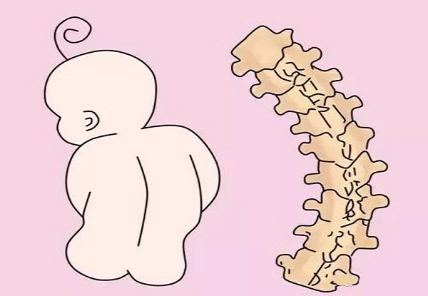 Phòng Ngừa Cong Vẹo Cột Sống Ở Trẻ Sơ Sinh