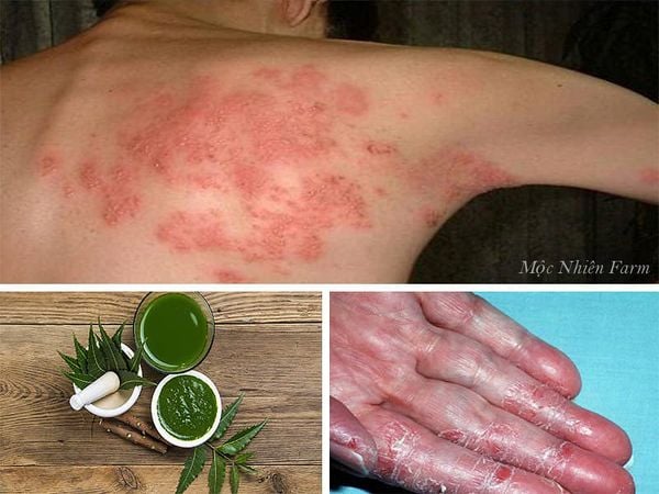 Tinh dầu trong lá neem hỗ trợ chữa trị một số bệnh về da.