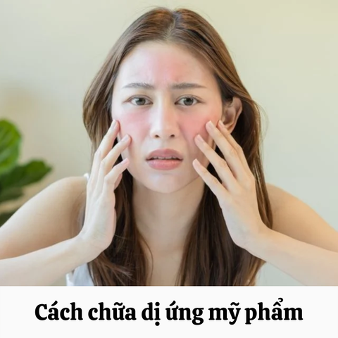 BỎ TÚI CÁCH CHỮA DỊ ỨNG MỸ PHẨM AN TOÀN, HIỆU QUẢ