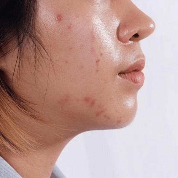 viêm da tiết bã