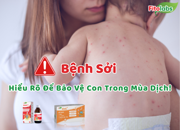 Bệnh Sởi: Hiểu Rõ Để Ba Mẹ Yên Tâm Bảo Vệ Con Trong Mùa Dịch!