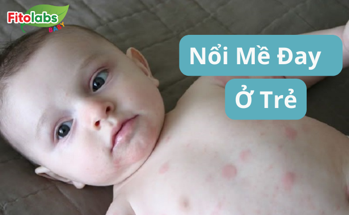 Nổi mề đay ở trẻ: Nguyên nhân và cách khắc phục hiệu quả | Fitolabs