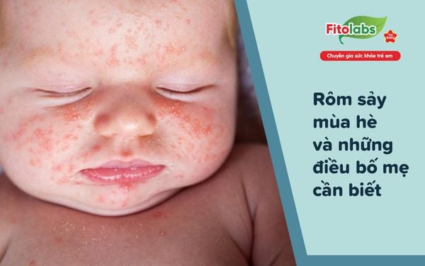 Rôm Sảy Mùa Hè Và Những Điều Bố Mẹ Cần Biết