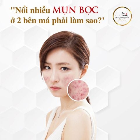 𝐍𝐎̂̉𝐈 𝐍𝐇𝐈𝐄̂̀𝐔 𝐌𝐔̣𝐍 𝐁𝐎̣𝐂 𝟐 𝐁𝐄̂𝐍 𝐌𝐀́ 𝐏𝐇𝐀̉𝐈 𝐋𝐀̀𝐌 𝐒𝐀𝐎?