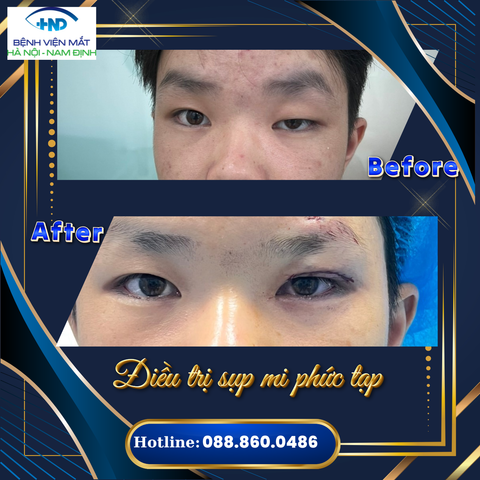 SỤP MÍ MẮT: Nguyên nhân - Dấu hiệu nhận biết - Phương pháp điều trị  - Cách phòng ngừa