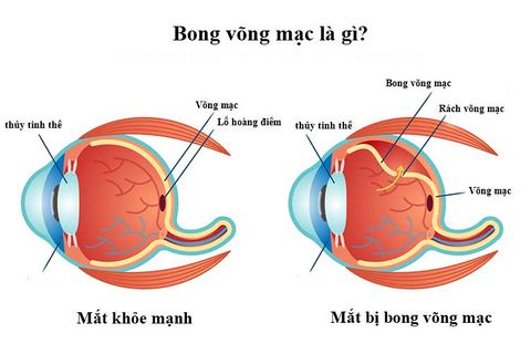 Bong võng mạc là gì? Các dấu hiệu nhận biết và phương pháp điều trị bệnh bong võng mạc