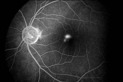 Hắc võng mạc trung tâm thanh dịch: Triệu chứng và phương pháp điều trị