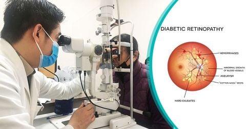 Bạn Đã Biết Gì Về Bệnh Võng Mạc Tiểu Đường?