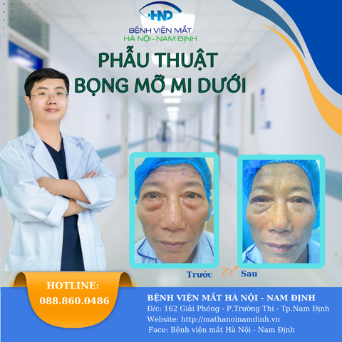 Phẫu thuật lấy mỡ mí mắt dưới hay còn gọi là Phẫu thuật bọng mỡ mắt.