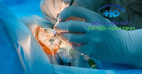 Mổ Phaco Đục Thủy Tinh Thể Có Đau Không? Giải Đáp Chi Tiết Từ Chuyên Gia