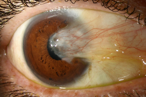 Phẫu thuật Mộng thịt trong mắt và những điều cần biết