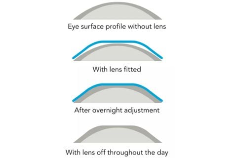 Kính tiếp xúc (Ortho K, mềm, cứng...)