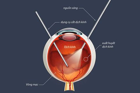 Xuất huyết dịch kính - Bệnh lý võng mạc có nguy cơ gây suy giảm thị lực nghiêm trọng