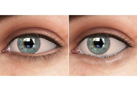 Quặm mi - Phương pháp điều trị quặm mi ở trẻ em và người lớn