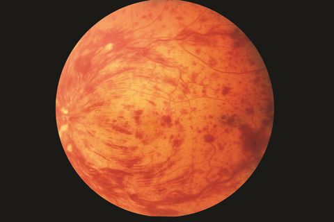 Tắc tĩnh mạch trung tâm võng mạc (CRVO) - Nguyên nhân và cách điều trị