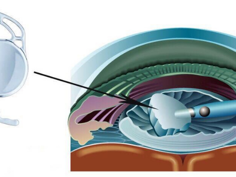 Các loại nhân thủy tinh thể nhân tạo