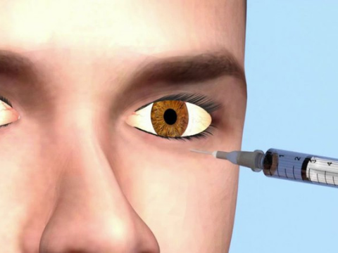 Bong võng mạc là gì, nguyên nhân, triệu chứng, cách điều trị và những biến chứng thường gặp