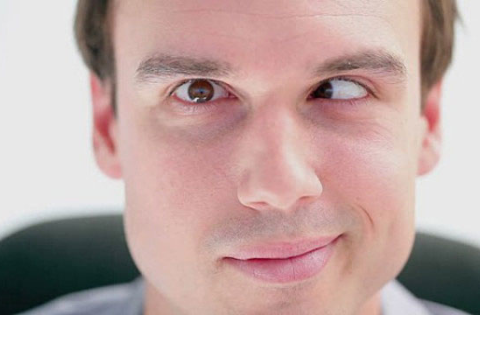 Phẫu thuật lác, không đơn thuần là giải quyết vấn đề thẩm mỹ