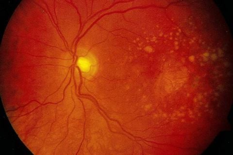 Thoái hóa hoàng điểm tuổi già: cách nhận biết và phương pháp điều trị
