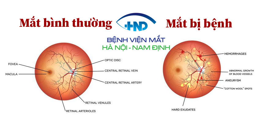 Võng mạc tiểu đường