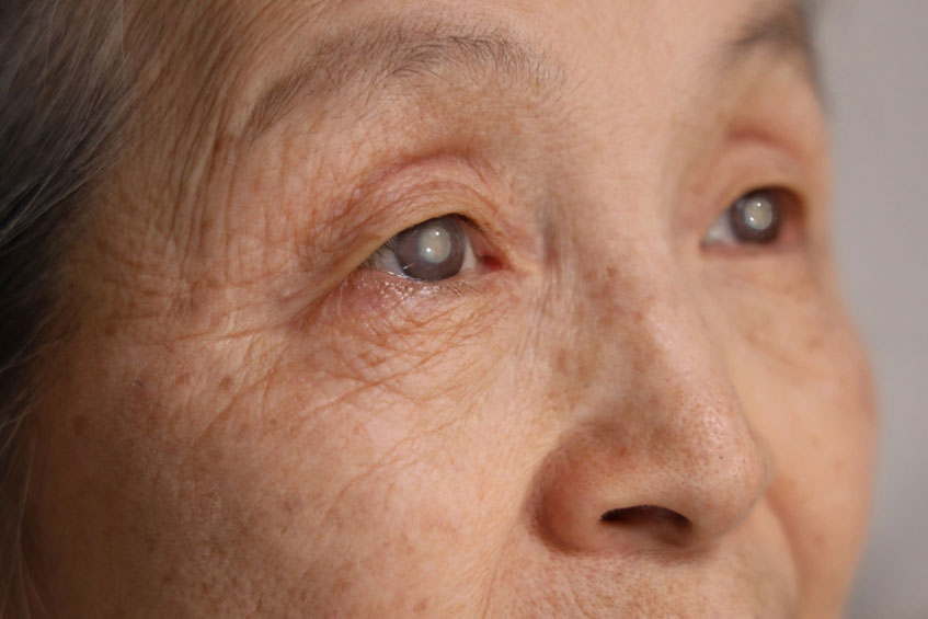 Bệnh đục thuỷ tinh thể