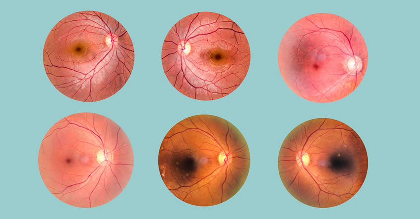 Thái hoá điểm vàng ở mắt