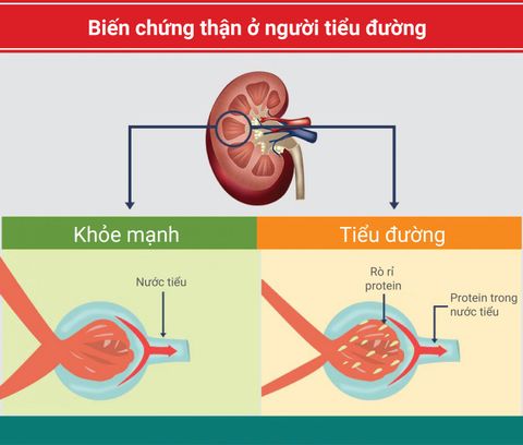 Điều trị bệnh thận mạn trên bệnh nhân tiểu đường type 2