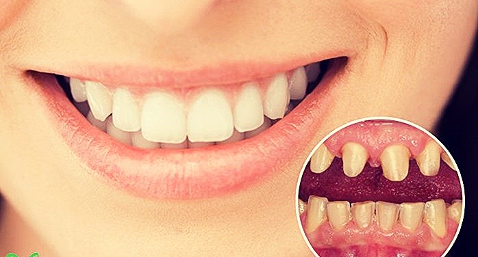 Khám phá độ bền vượt trội của răng sứ Lava Plus Khám phá độ bền vượt trội của răng sứ Lava Plus