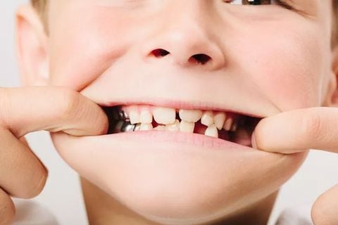 Trẻ uống sữa có gây sâu răng không? Cách phòng ngừa sâu răng khi cho bé uống sữa