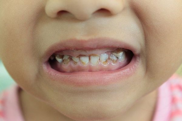 Cách phòng tránh sâu răng do uống sữa hiệu quả