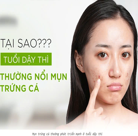 XÔNG HƠI TOÀN THÂN BẰNG THẢO MỘC – CÁCH TRỊ MỤN TỰ NHIÊN, AN TOÀN CHO CÁC BÉ TUỔI DẬY THÌ