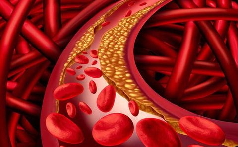 Mỡ máu là gì và cách ổn định bền vững