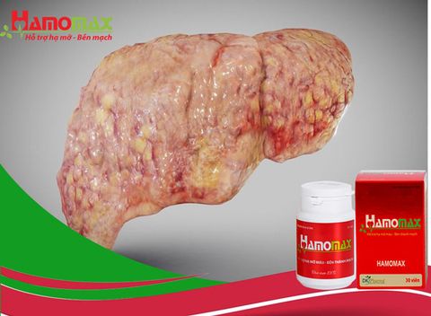 Hamomax chia sẻ bệnh gan nhiễm mỡ độ 2 và cách điều trị hiệu quả nhất hiện nay