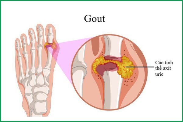 Nấm Lim Xanh Hổ Trợ Bệnh Gout Như Thế Nào