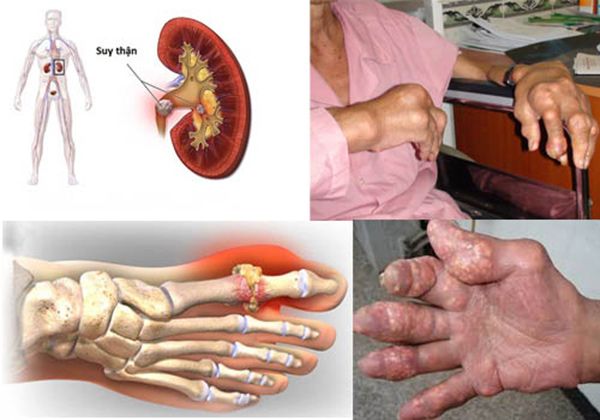Những biến chứng của bệnh Gout
