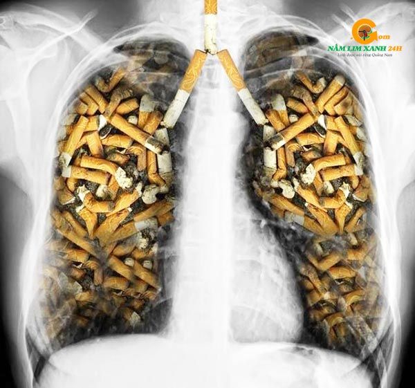 Hút thuốc lá là nguyên nhân gây ra bệnh ung thư phổi.