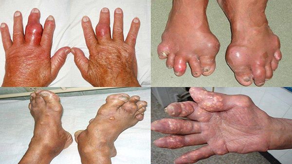 Triệu chứng bệnh Gout
