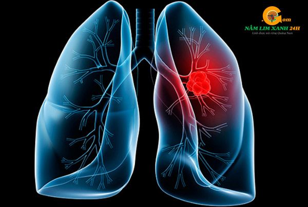 Nấm lim xanh hỗ trợ điều trị ung thư phổi.
