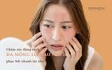 DA MỎNG LỘ MAO MẠCH LÀ GÌ? NÊN CHĂM SÓC DA MẶT MỎNG NỔI MẠCH THẾ NÀO?