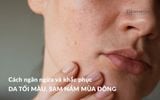 Cách ngăn ngừa và khắc phục da tối màu, sạm nám mùa đông