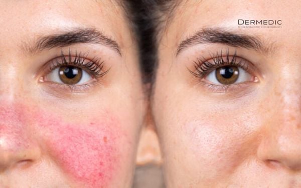 Rosacea và những triệu chứng thường gặp