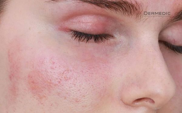 Da mặt bị nổi mẩn đỏ là vì sao, nguyên nhân dẫn đến là gì