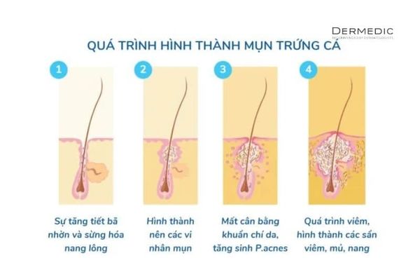 Cơ thế gây mụn của vi khuẩn P.acnes