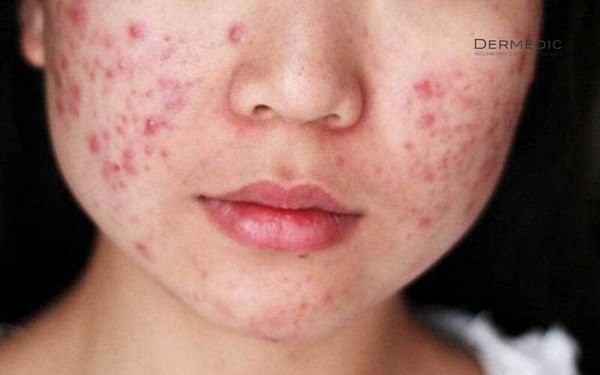 Vi khuẩn P.acnes là gì